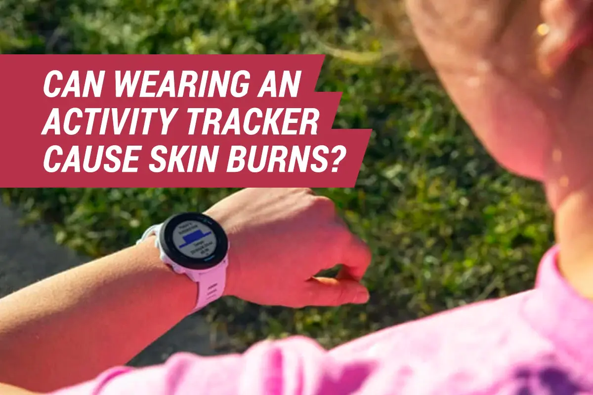 Can Wearing a Fitbit or Garmin Activity Tracker Cause Skin Burns